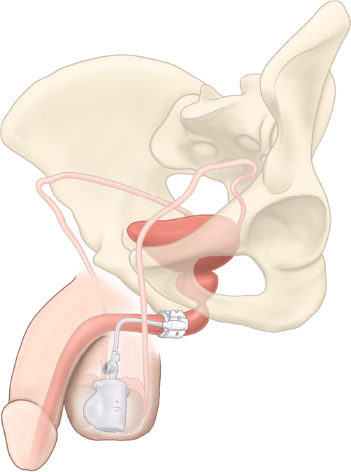 Abbildung einer Blasenschliessmuskel-Prothese