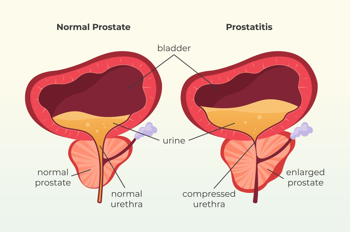 Prostatitis Schaubild